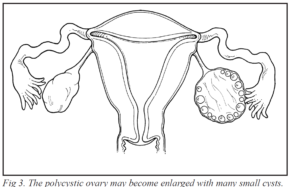 hirsutism-Fig3.png